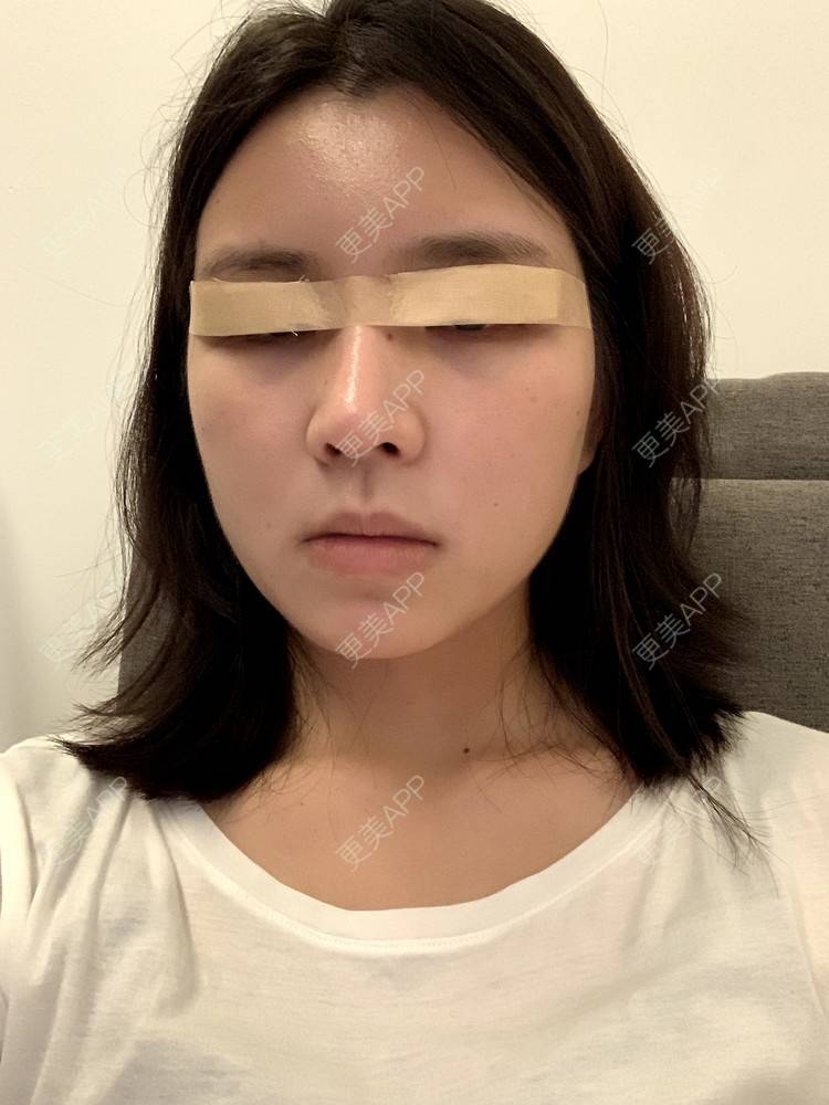 更美 - 更美用户B670A6hUBe的眼部综合经验 | 眼部综合 | 广州