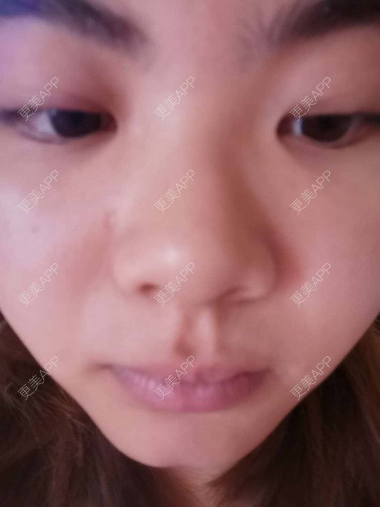更美 - 不一“斑”的人的激光淡化红血丝经验 | 激光淡斑 | 祛斑祛色素 | 化学剥脱淡斑 | 皮秒激光 | 淡斑套餐