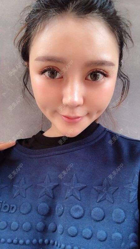 更美 - rightthere的酒窝成形经验 | 酒窝成形 | 武汉