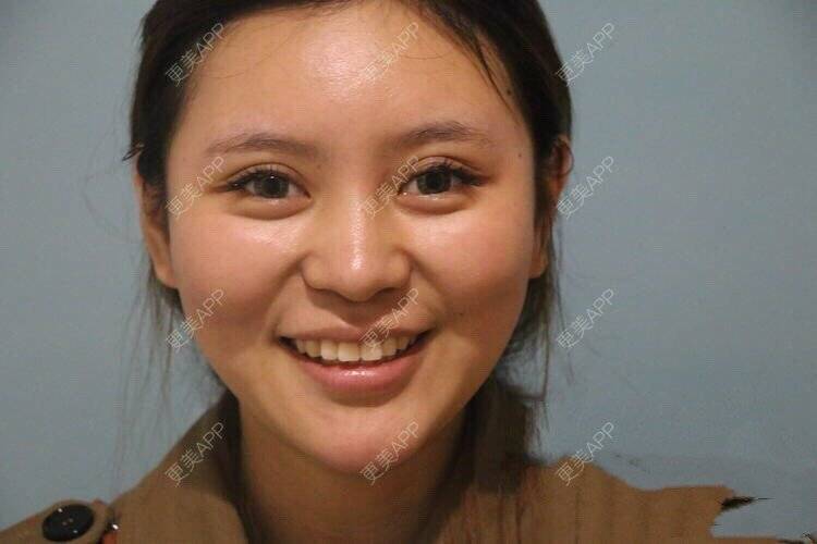更美 - rightthere的酒窝成形经验 | 酒窝成形 | 武汉