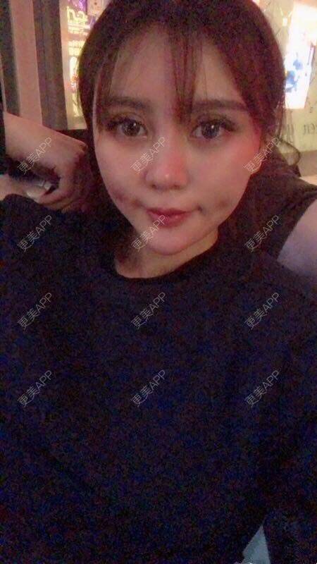更美 - rightthere的酒窝成形经验 | 酒窝成形 | 武汉