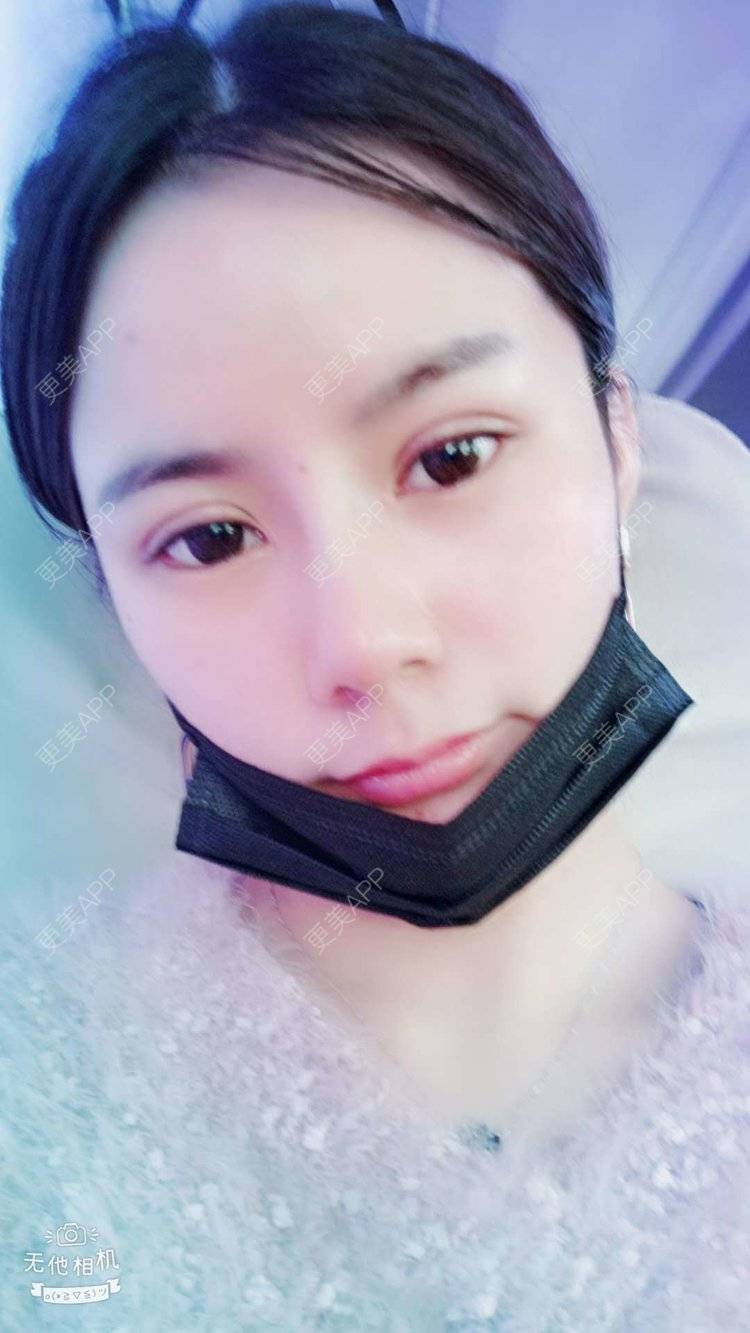 更美 - 更美用户tqiUzMAnQM的膨体隆鼻经验 | 膨体隆鼻 | 杭州