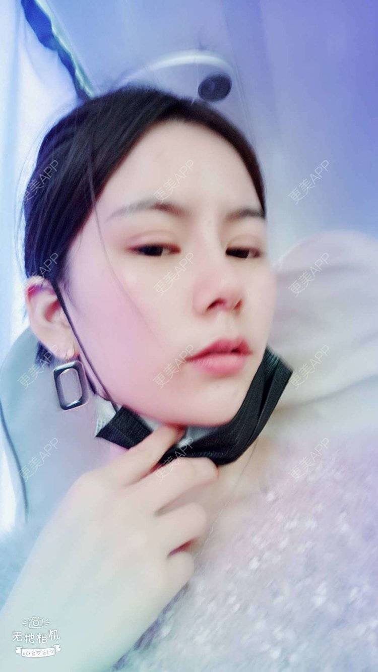 更美 - 更美用户tqiUzMAnQM的膨体隆鼻经验 | 膨体隆鼻 | 杭州