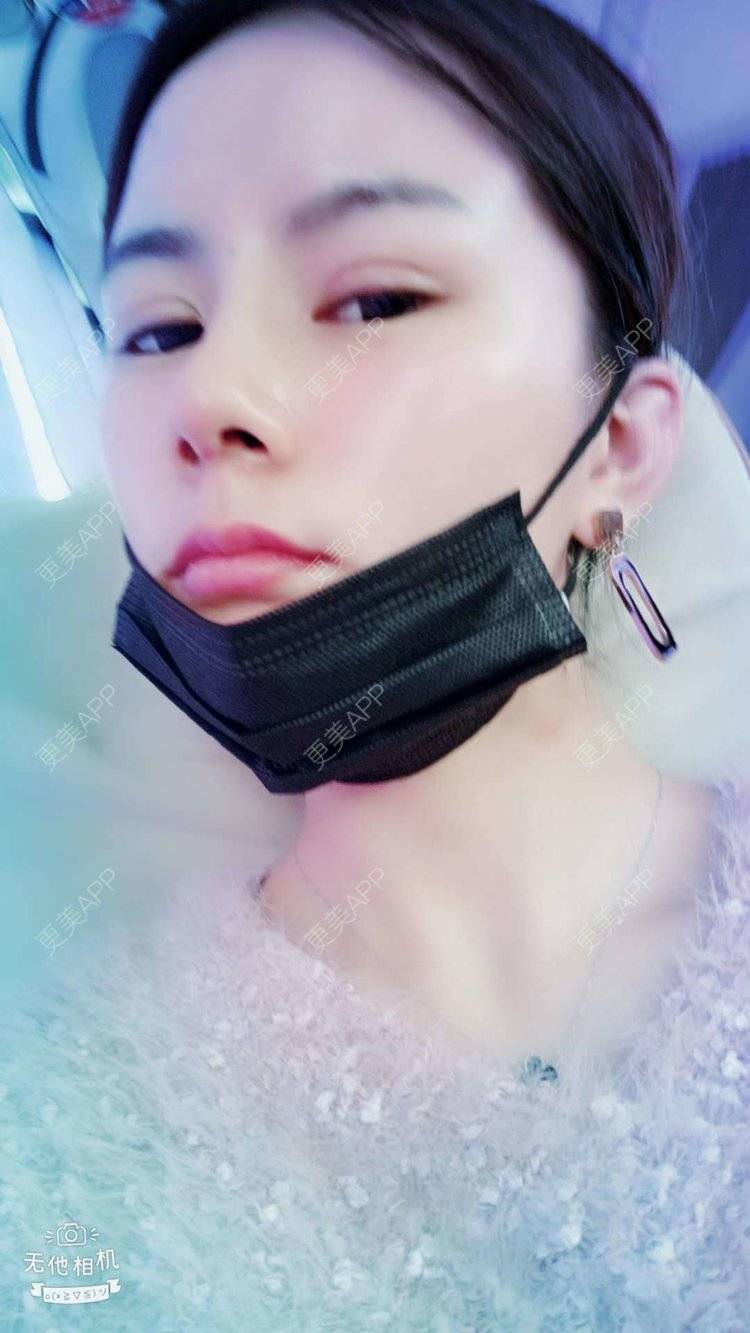 更美 - 更美用户tqiUzMAnQM的膨体隆鼻经验 | 膨体隆鼻 | 杭州
