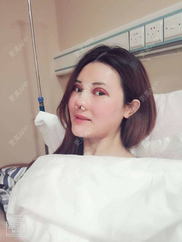 更美 - 更美用户M85cfJCnpD的膨体隆鼻经验 | 膨体隆鼻 | 杭州