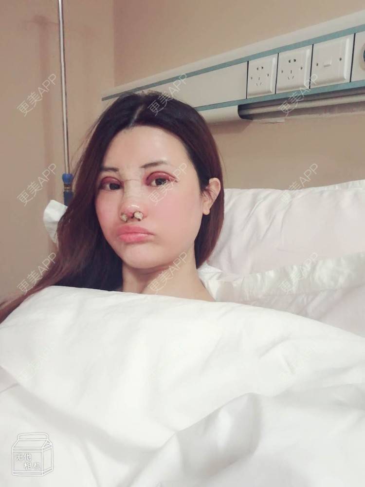 更美 - 更美用户M85cfJCnpD的膨体隆鼻经验 | 膨体隆鼻 | 杭州