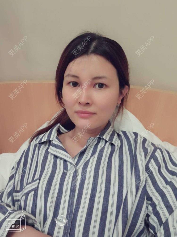 更美 - 更美用户M85cfJCnpD的膨体隆鼻经验 | 膨体隆鼻 | 杭州