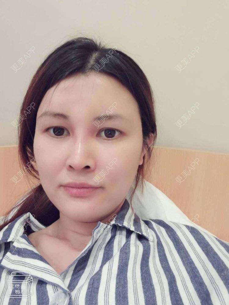 更美 - 更美用户M85cfJCnpD的膨体隆鼻经验 | 膨体隆鼻 | 杭州