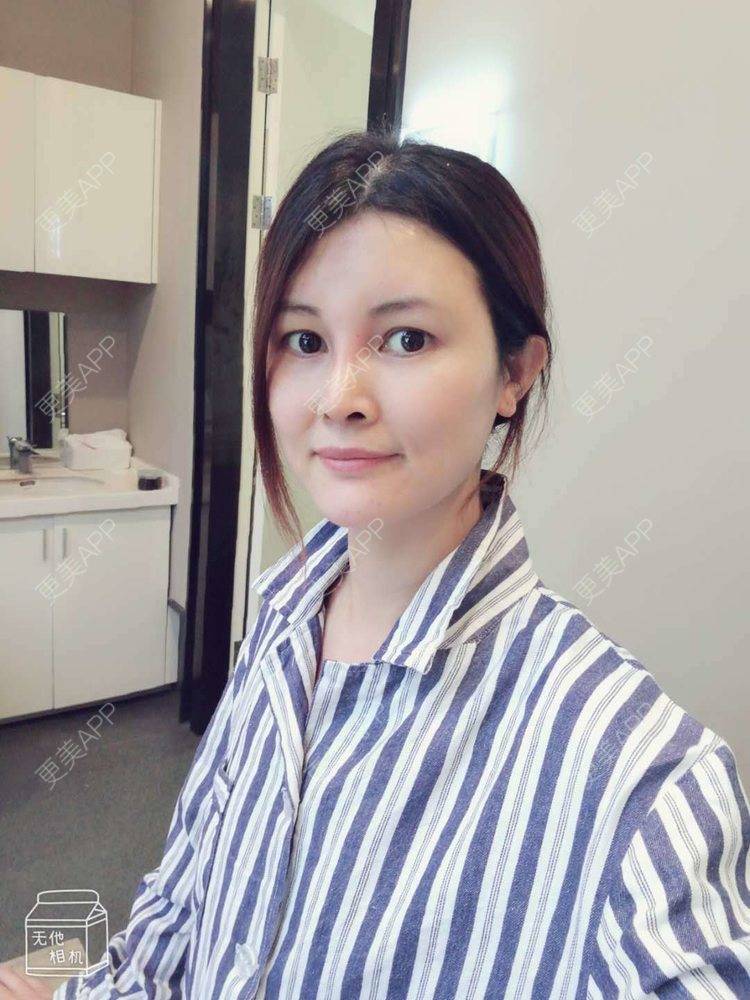 更美 - 更美用户M85cfJCnpD的膨体隆鼻经验 | 膨体隆鼻 | 杭州