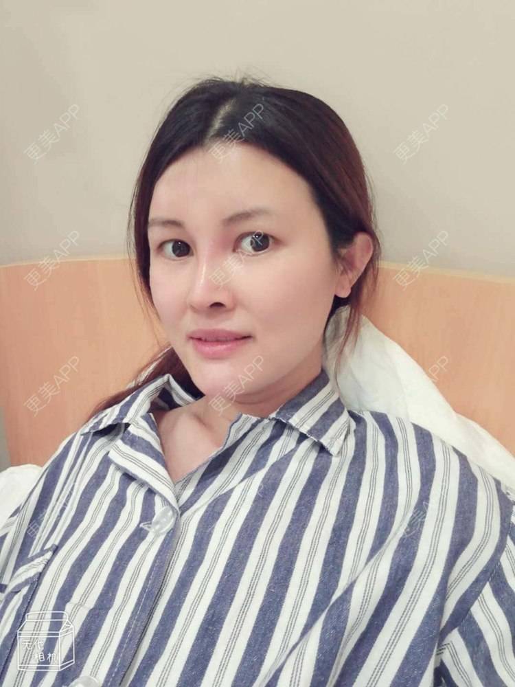 更美 - 更美用户M85cfJCnpD的膨体隆鼻经验 | 膨体隆鼻 | 杭州