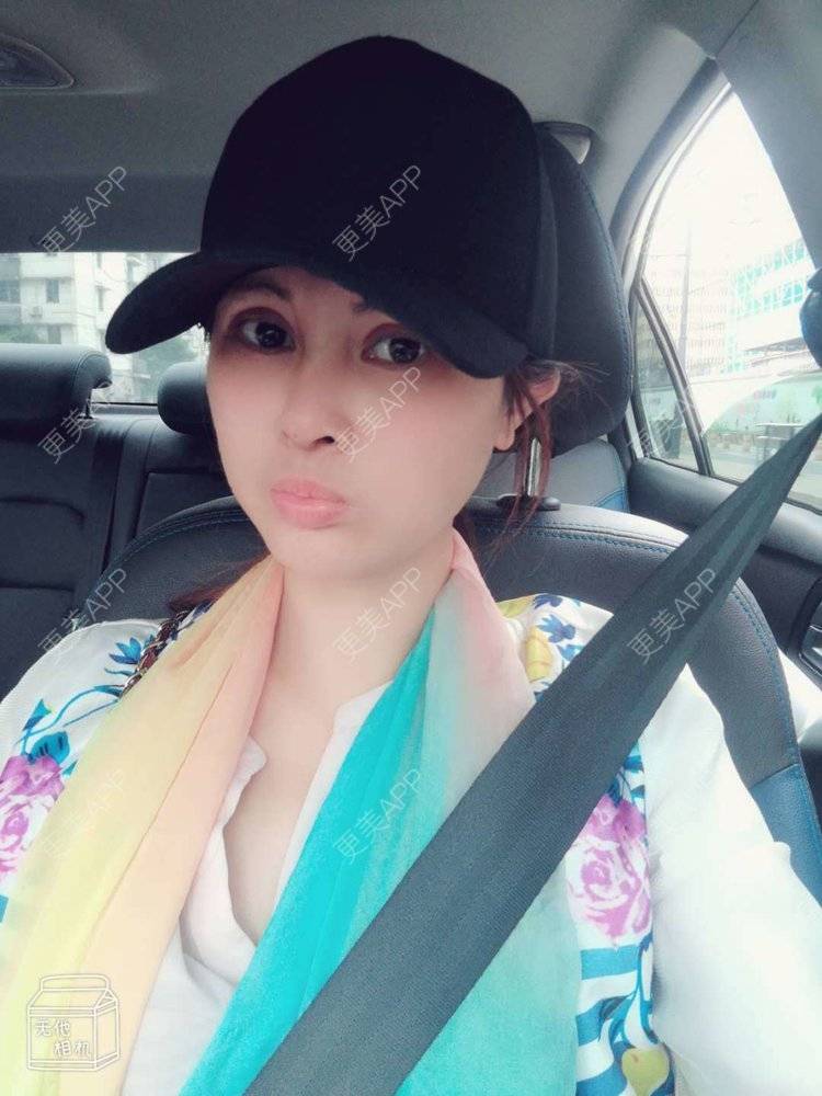 更美 - 更美用户M85cfJCnpD的膨体隆鼻经验 | 膨体隆鼻 | 杭州