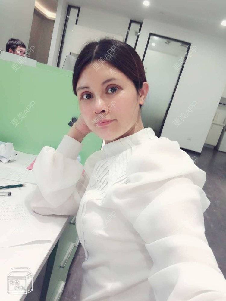 更美 - 更美用户M85cfJCnpD的膨体隆鼻经验 | 膨体隆鼻 | 杭州
