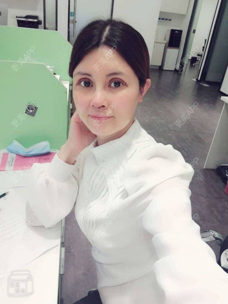 更美 - 更美用户M85cfJCnpD的膨体隆鼻经验 | 膨体隆鼻 | 杭州