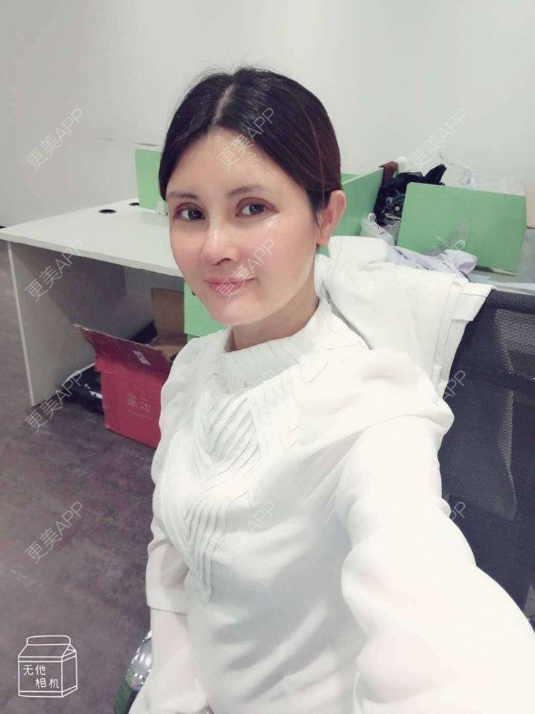 更美 - 更美用户M85cfJCnpD的膨体隆鼻经验 | 膨体隆鼻 | 杭州
