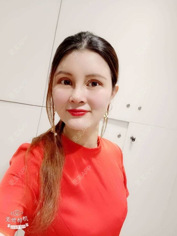 更美 - 更美用户M85cfJCnpD的膨体隆鼻经验 | 膨体隆鼻 | 杭州