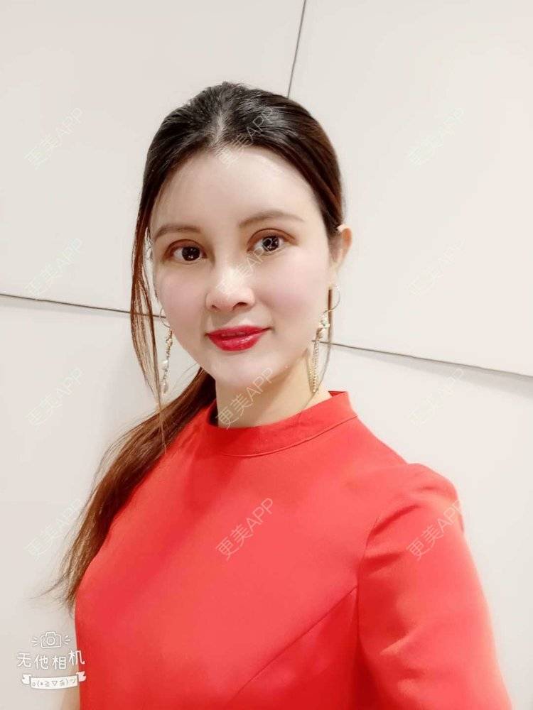 更美 - 更美用户M85cfJCnpD的膨体隆鼻经验 | 膨体隆鼻 | 杭州