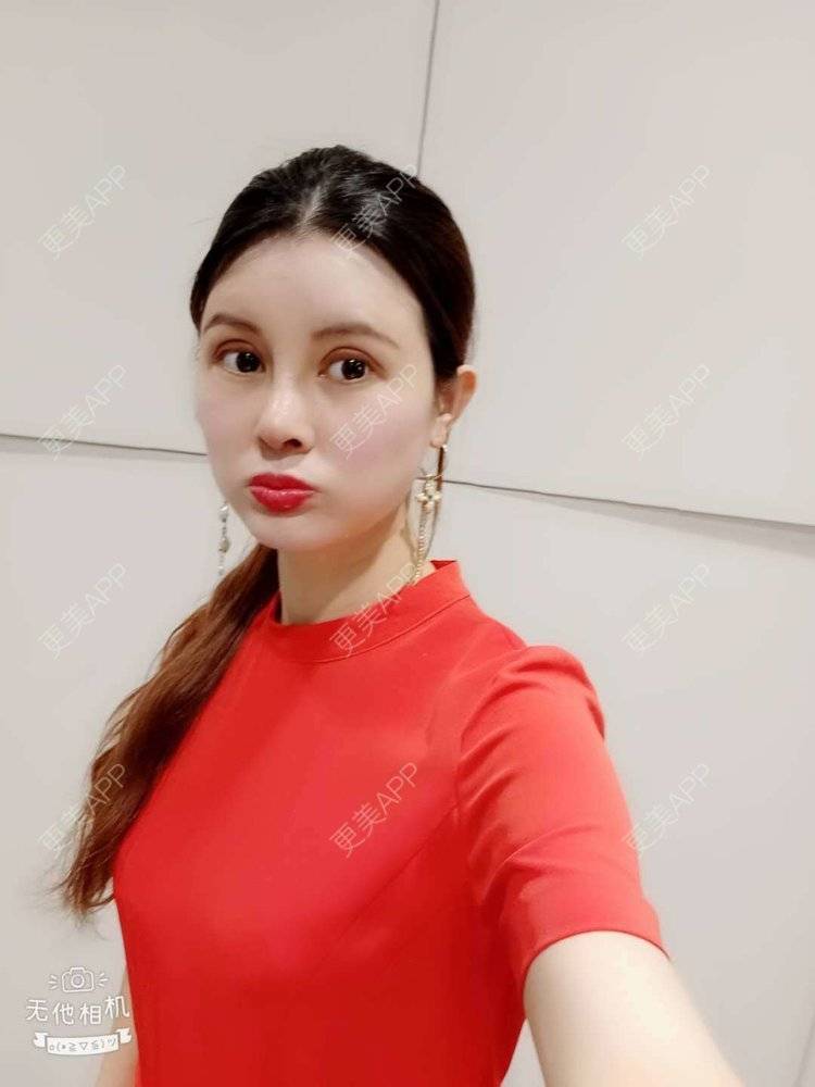更美 - 更美用户M85cfJCnpD的膨体隆鼻经验 | 膨体隆鼻 | 杭州