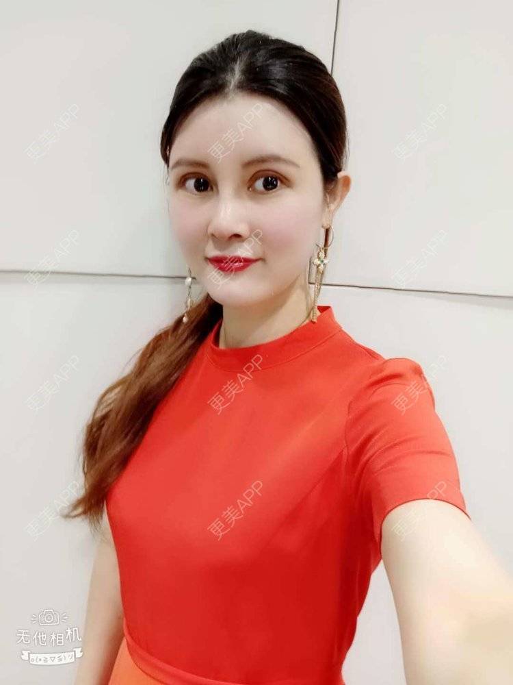 更美 - 更美用户M85cfJCnpD的膨体隆鼻经验 | 膨体隆鼻 | 杭州