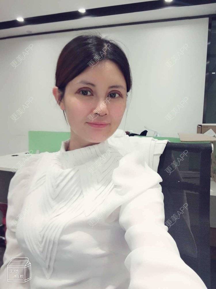 更美 - 更美用户M85cfJCnpD的膨体隆鼻经验 | 膨体隆鼻 | 杭州