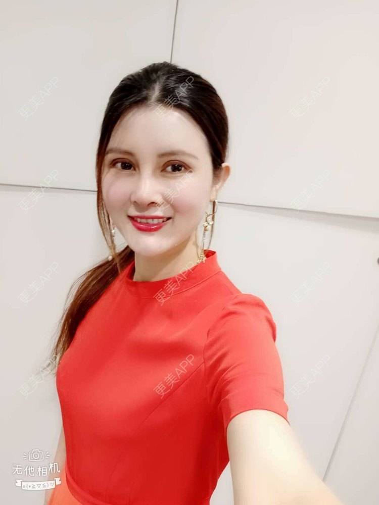 更美 - 更美用户M85cfJCnpD的膨体隆鼻经验 | 膨体隆鼻 | 杭州