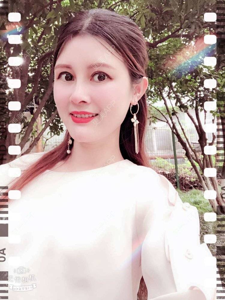 更美 - 更美用户M85cfJCnpD的膨体隆鼻经验 | 膨体隆鼻 | 杭州