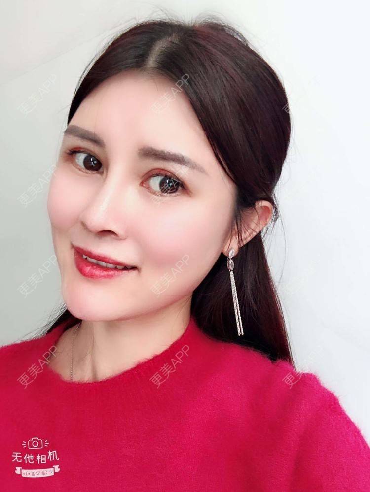 更美 - 更美用户M85cfJCnpD的膨体隆鼻经验 | 膨体隆鼻 | 杭州