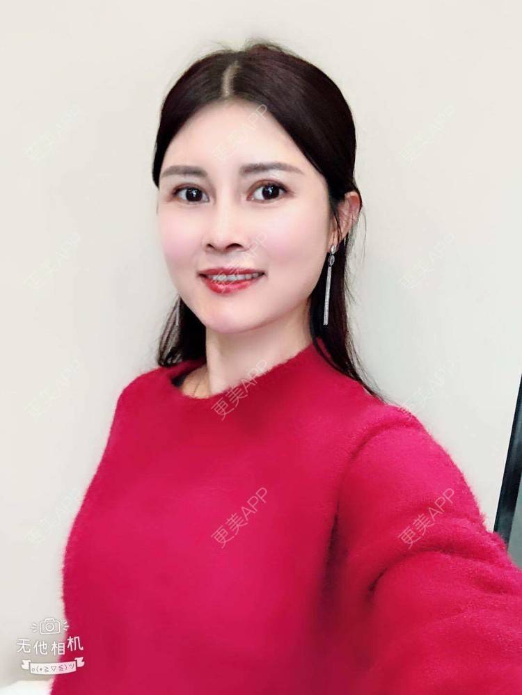 更美 - 更美用户M85cfJCnpD的膨体隆鼻经验 | 膨体隆鼻 | 杭州
