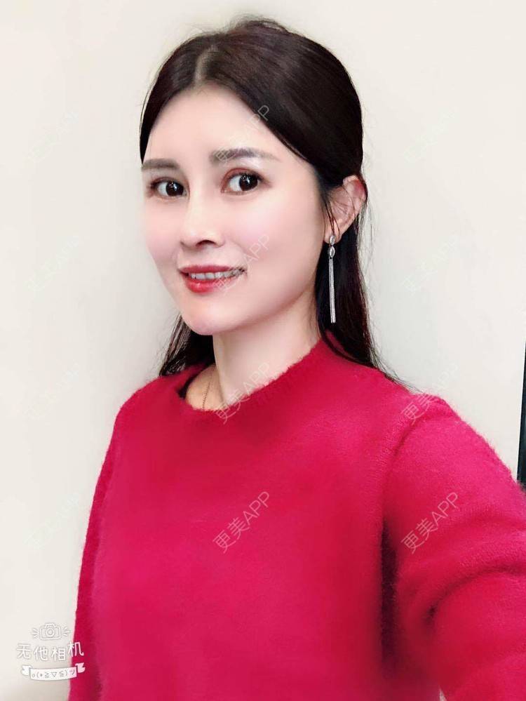 更美 - 更美用户M85cfJCnpD的膨体隆鼻经验 | 膨体隆鼻 | 杭州