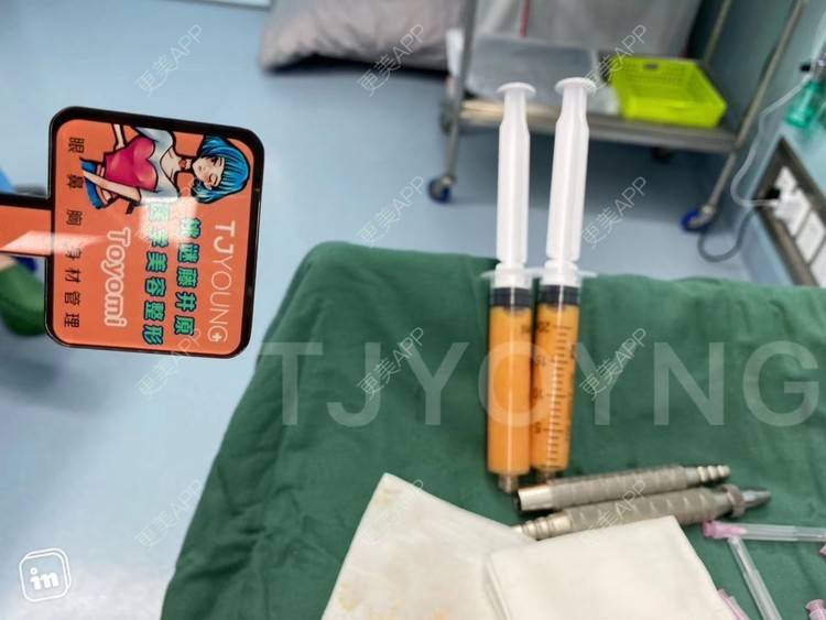 更美 - Luna4581的激光溶脂瘦脸经验 | 射频溶脂 | 激光溶脂瘦脸 | 上海