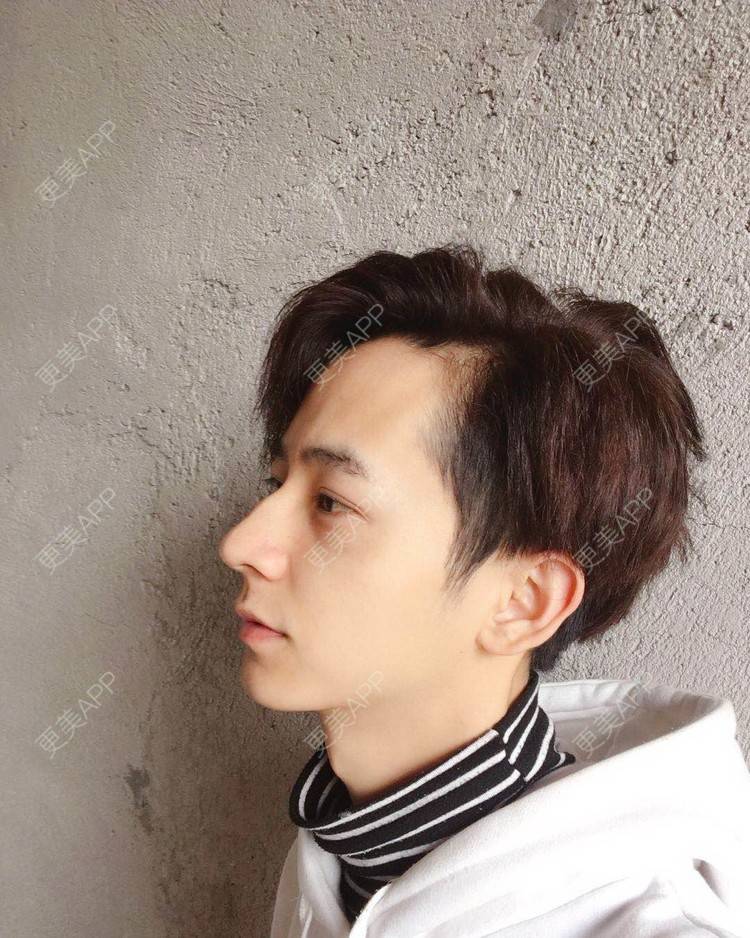 更美 - 更美用户5C823K4VCw的埋线双眼皮经验 | 广州 | 视频日记 | 埋线双眼皮