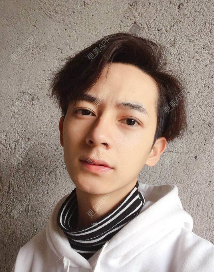 更美 - 更美用户5C823K4VCw的埋线双眼皮经验 | 广州 | 视频日记 | 埋线双眼皮