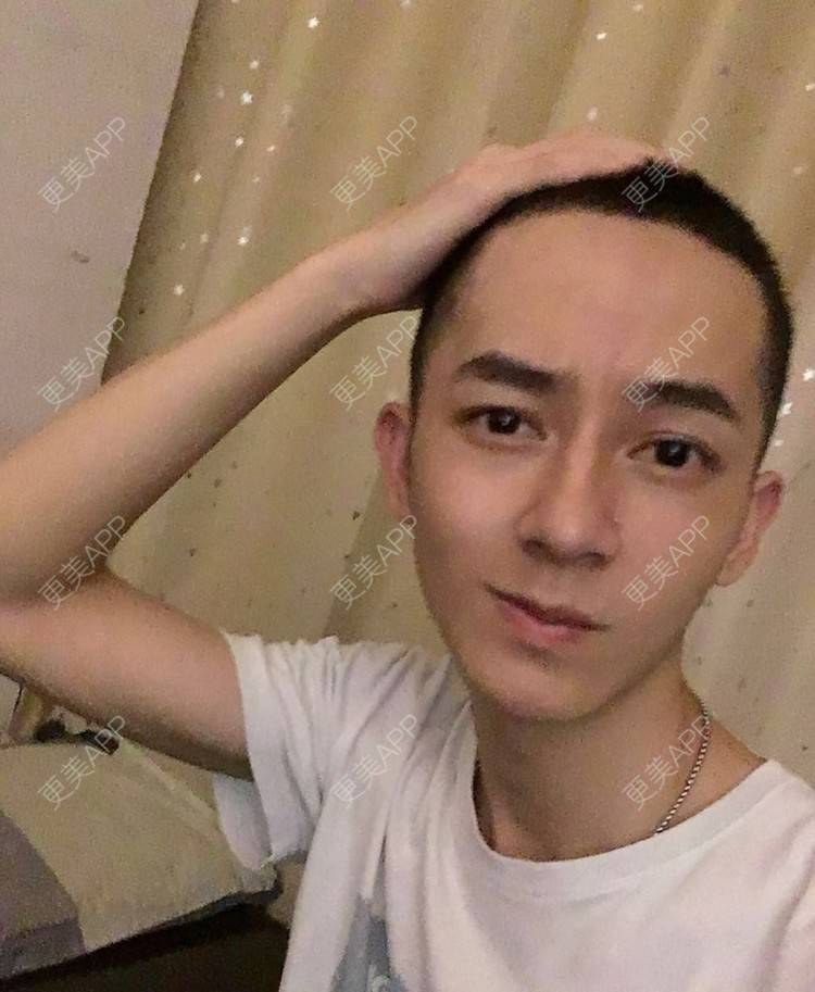 更美 - 更美用户5C823K4VCw的埋线双眼皮经验 | 广州 | 视频日记 | 埋线双眼皮