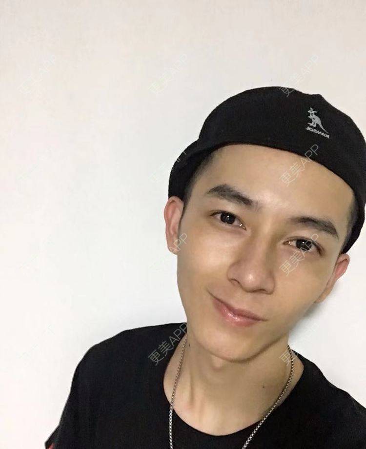 更美 - 更美用户5C823K4VCw的埋线双眼皮经验 | 广州 | 视频日记 | 埋线双眼皮