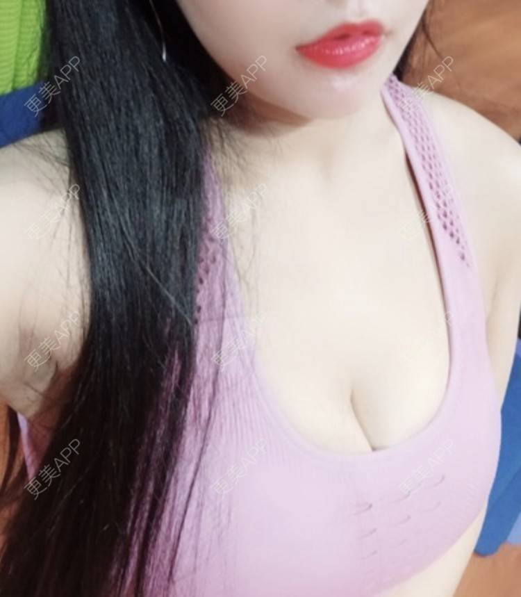 更美 - 更美用户2OKwREKTAv的假体隆胸经验 | 假体隆胸 | 青岛