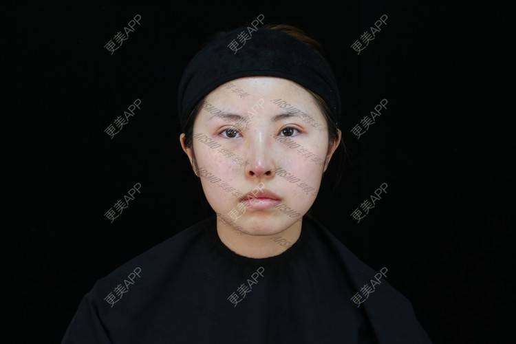 更美 - 北柠陌寒.的鼻部多项经验 | 微晶瓷隆鼻 | 肋软骨隆鼻 | 鼻部多项 | 隆鼻 | 膨体隆鼻 | 视频日记 | 长沙