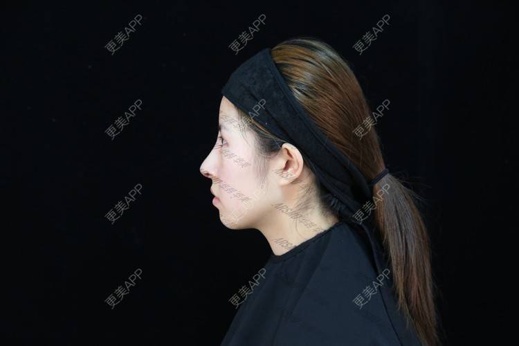 更美 - 北柠陌寒.的鼻部多项经验 | 微晶瓷隆鼻 | 肋软骨隆鼻 | 鼻部多项 | 隆鼻 | 膨体隆鼻 | 视频日记 | 长沙