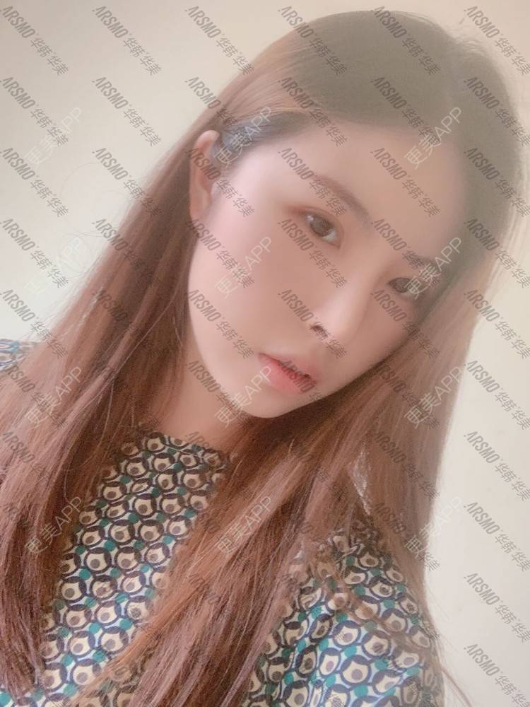 更美 - 北柠陌寒.的鼻部多项经验 | 微晶瓷隆鼻 | 肋软骨隆鼻 | 鼻部多项 | 隆鼻 | 膨体隆鼻 | 视频日记 | 长沙