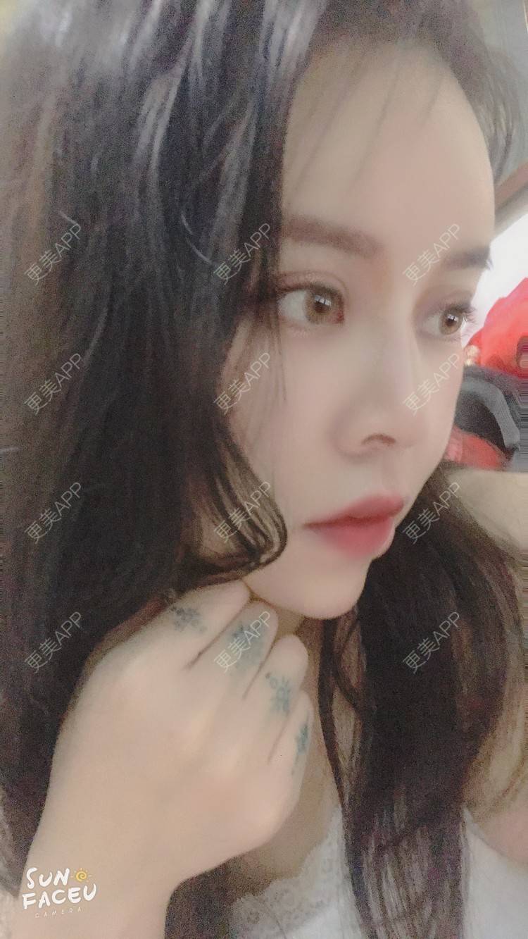 更美 - 更美用户iuB00h31N3的鼻部多项经验 | 鼻部多项 | 肋软骨隆鼻 | 广州