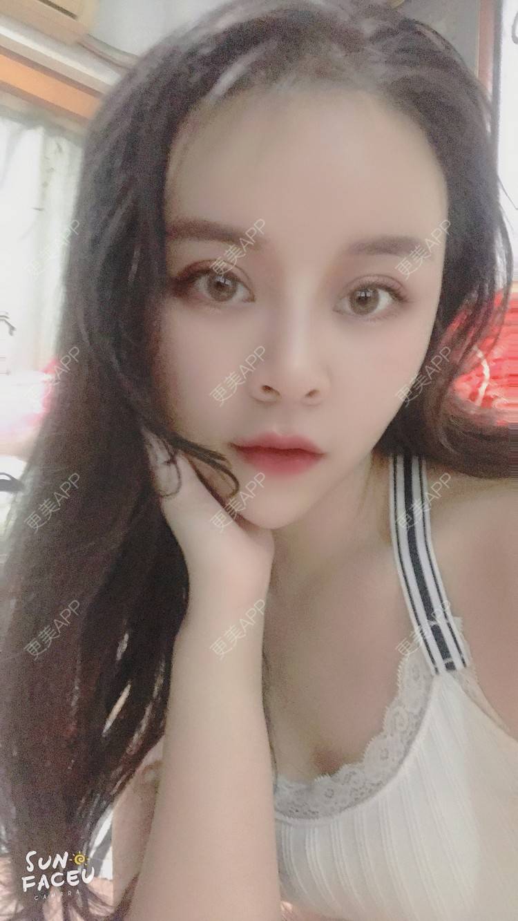 更美 - 更美用户iuB00h31N3的鼻部多项经验 | 鼻部多项 | 肋软骨隆鼻 | 广州