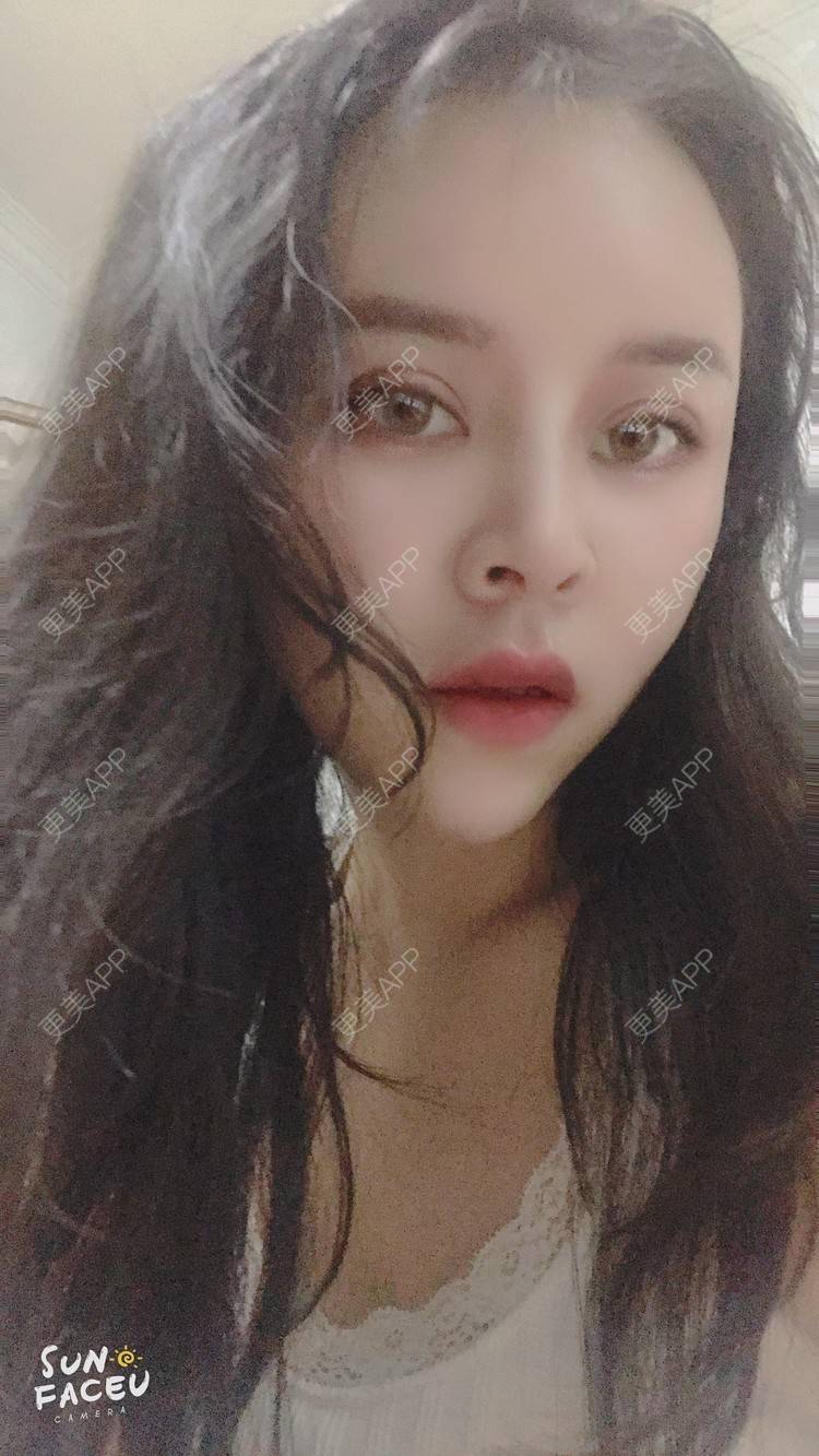 更美 - 更美用户iuB00h31N3的鼻部多项经验 | 鼻部多项 | 肋软骨隆鼻 | 广州