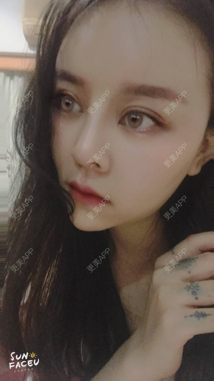 更美 - 更美用户iuB00h31N3的鼻部多项经验 | 鼻部多项 | 肋软骨隆鼻 | 广州