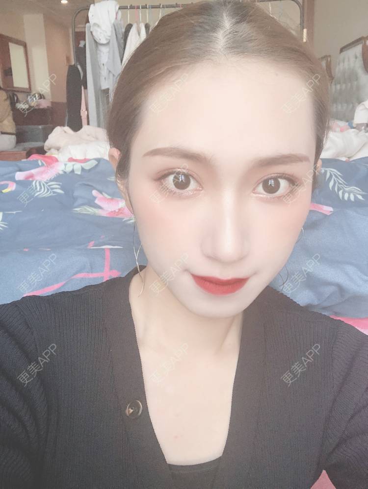 更美 - coollol的鼻部多项经验 | 鼻部多项 | 玻尿酸鼻部 | 肋软骨隆鼻 | 胶原蛋白隆鼻 | 埋线隆鼻 | 自体肋软骨垫鼻基底 | 成都