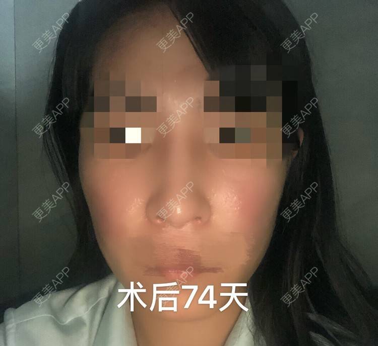 更美 - 向日葵55的鼻部多项经验 | 膨体隆鼻 | 耳软骨隆鼻 | 鼻翼缩小 | 鼻部多项 | 鼻小柱延长 | 上海
