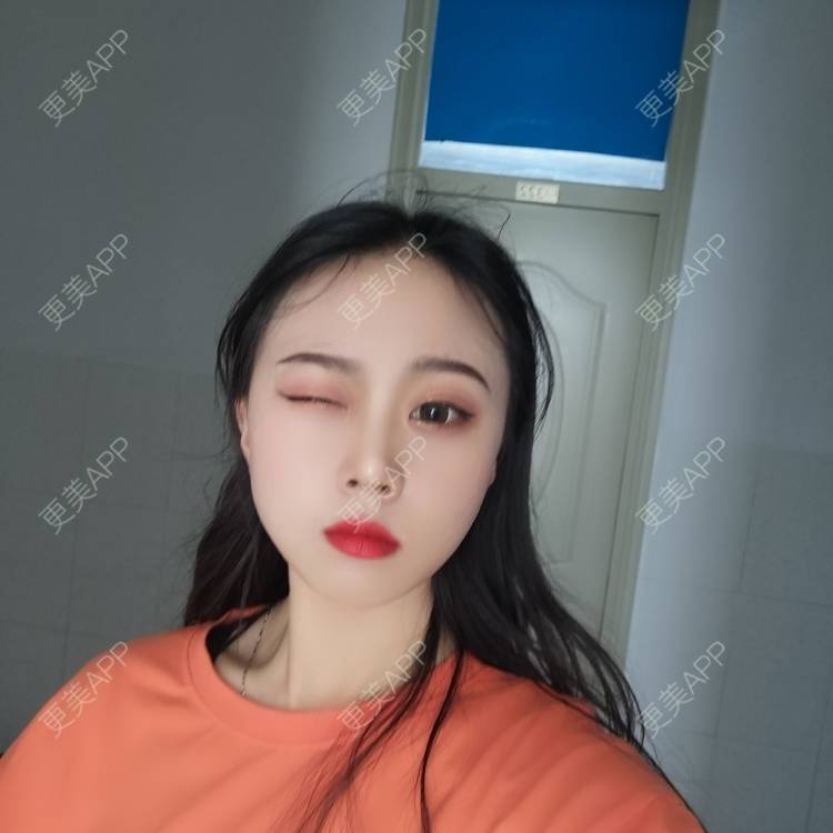 更美 - 更美用户vFETzv4uga的自体脂肪全面部填充经验 | 广州 | 自体脂肪全面部填充