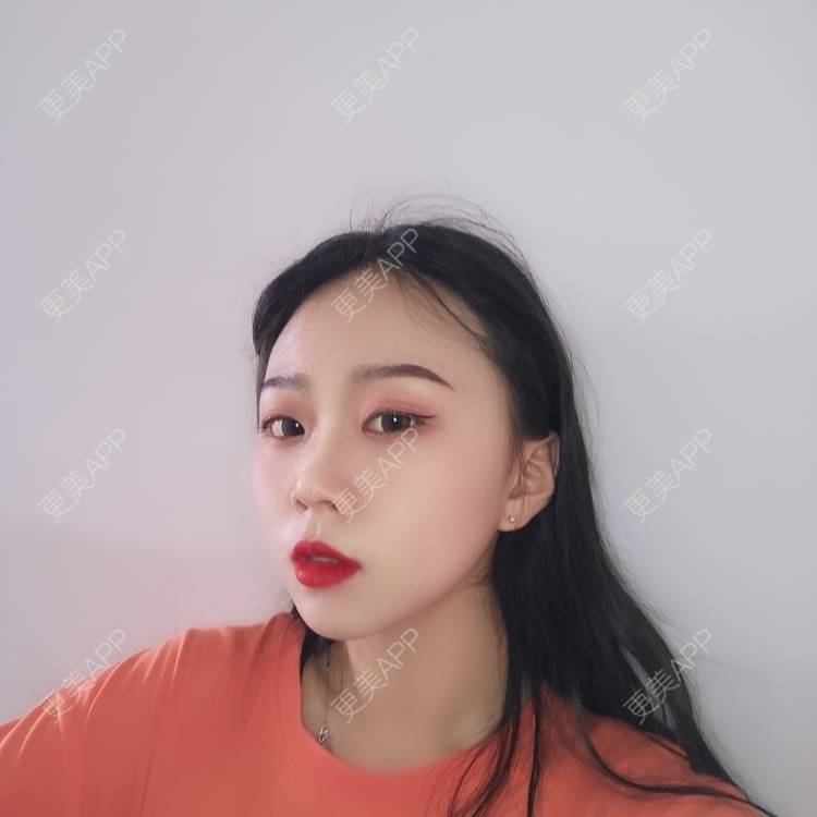 更美 - 更美用户vFETzv4uga的自体脂肪全面部填充经验 | 广州 | 自体脂肪全面部填充