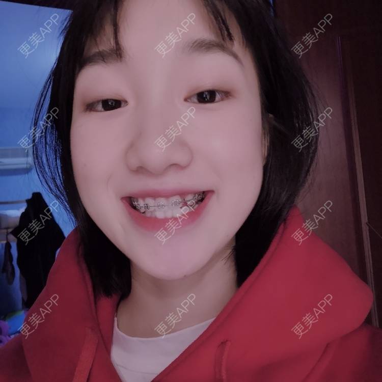 更美 - 此颜差矣^的错颌锁颌经验 | 错颌锁颌 | 更美研究所