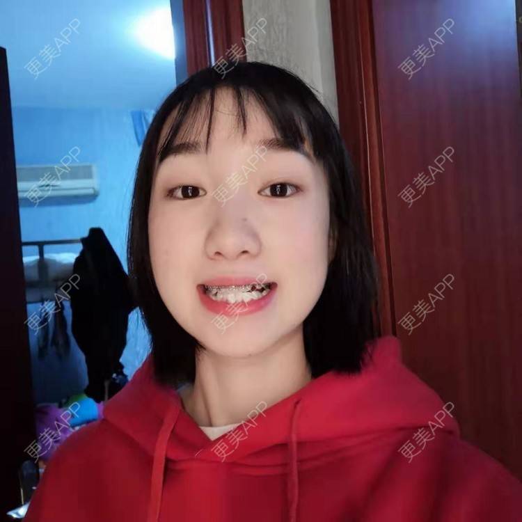 更美 - 此颜差矣^的错颌锁颌经验 | 错颌锁颌 | 更美研究所