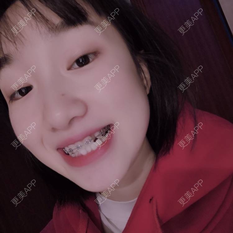 更美 - 此颜差矣^的错颌锁颌经验 | 错颌锁颌 | 更美研究所