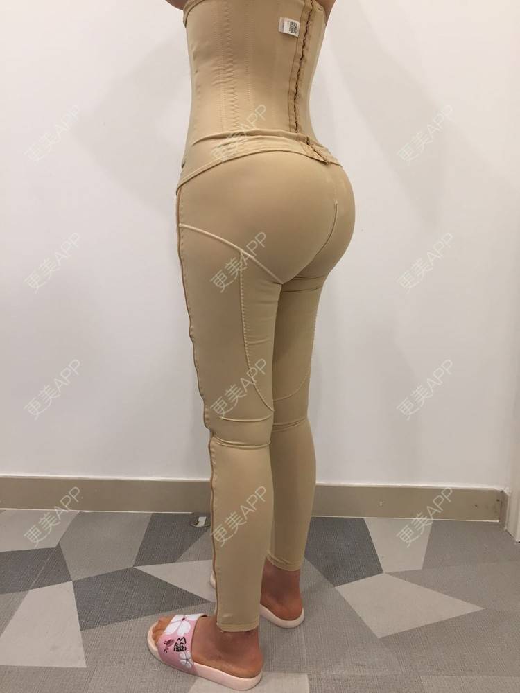 臀部,臀部手术_更美用户hxod876bje臀部手术_术后25天__更美整形