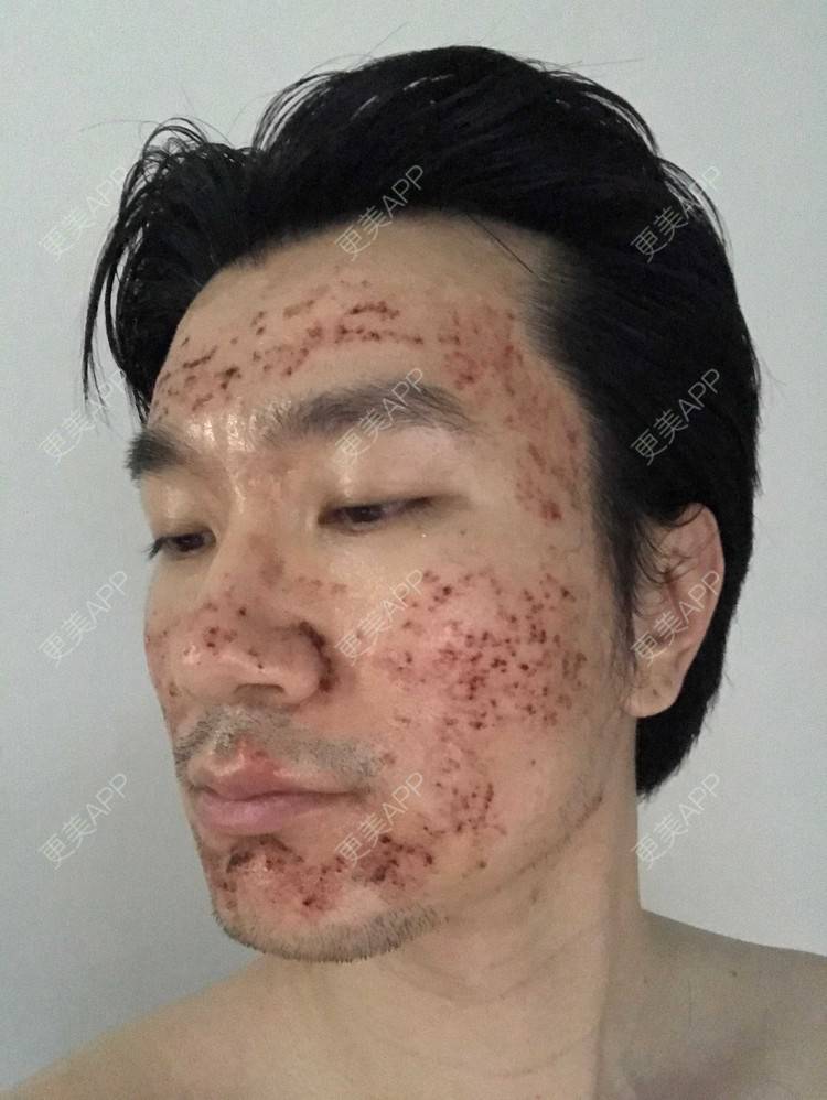 更美用户z3tkrxhjdx的祛疤痕痘印日记